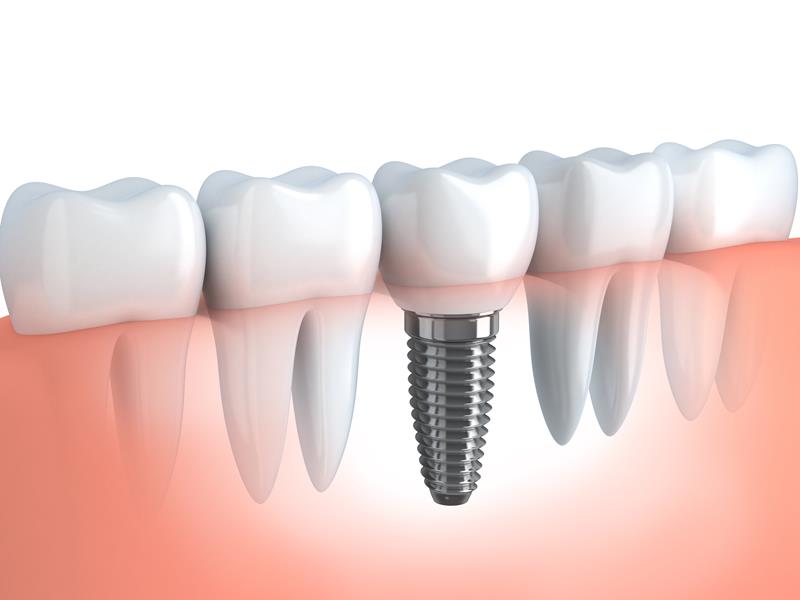 Dental Implants  Beebe, AR 