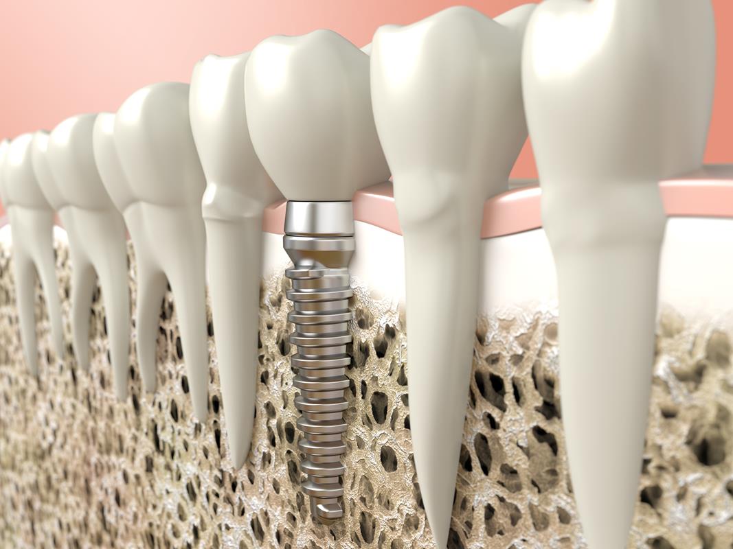 Dental Implants  Beebe, AR 