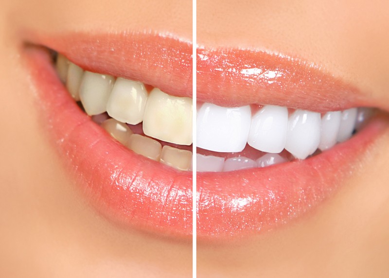 Teeth Whitening  Beebe, AR 